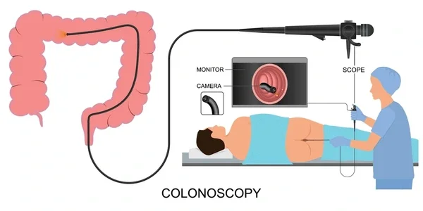 Doctor performing Colonoscopy