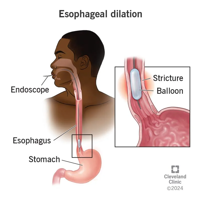Esophageal Dilation