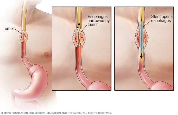 Metal Stenting