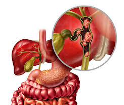 Pancreatic-Diseases